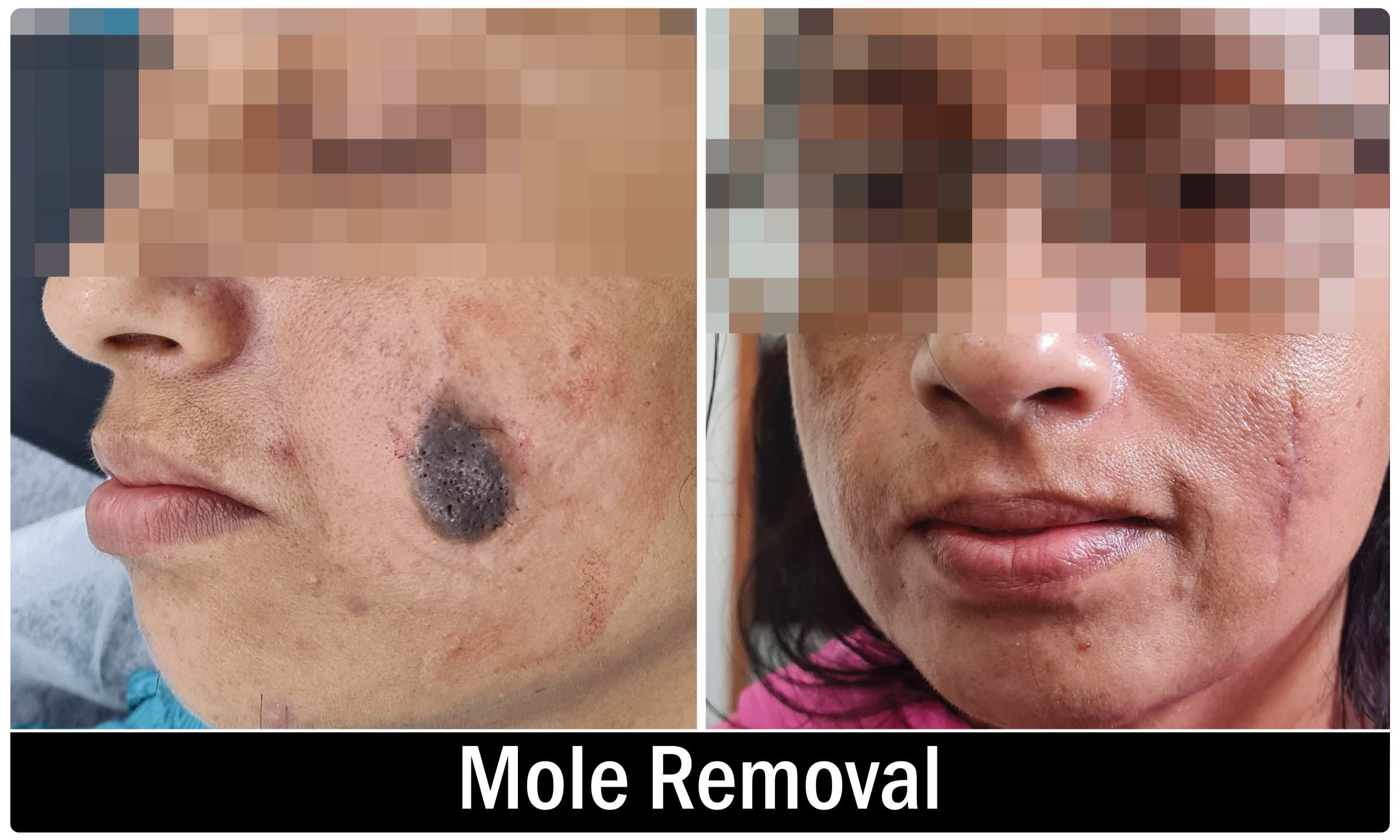 Mole Removal KOQ10